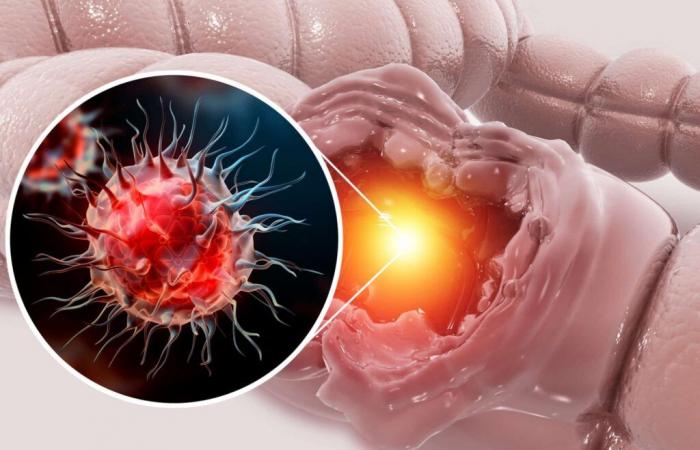 Elle vit dans vos intestins… et pourrait être liée à l’explosion des cancers colorectaux chez les jeunes -.